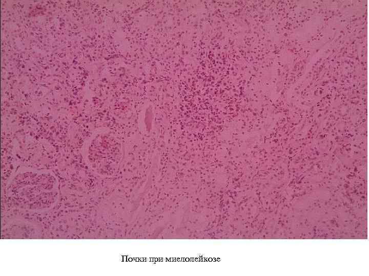 Почки при миелолейкозе 