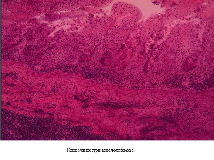 Кишечник при миелолейкозе 