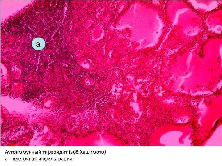 Аутоиммунный тиреоидит (зоб Хашимото) а – клеточная инфильтрация 