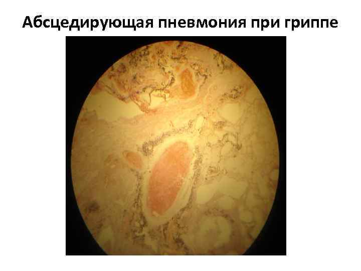 Абсцедирующая пневмония при гриппе 