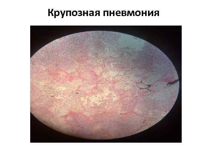 Крупозная пневмония 