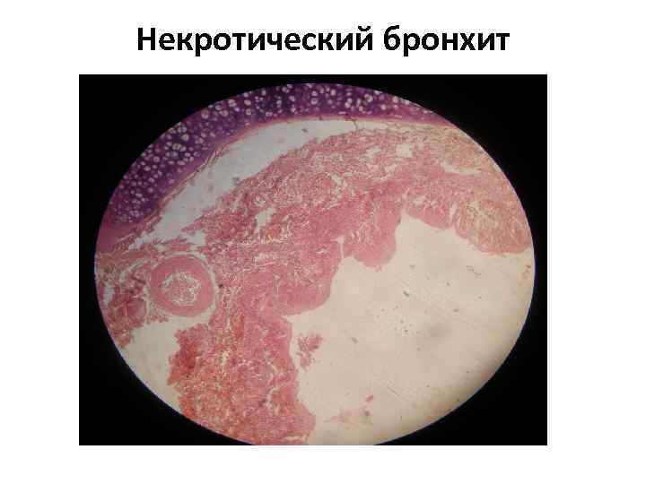 Некротический бронхит 