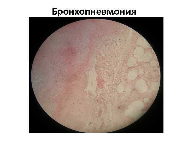 Бронхопневмония 