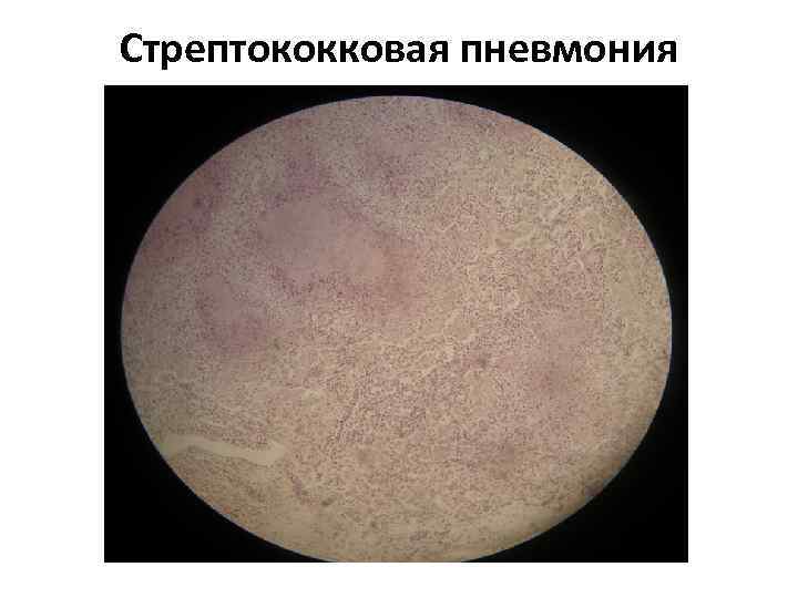 Стрептококковая пневмония 