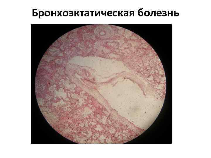 Бронхоэктатическая болезнь 