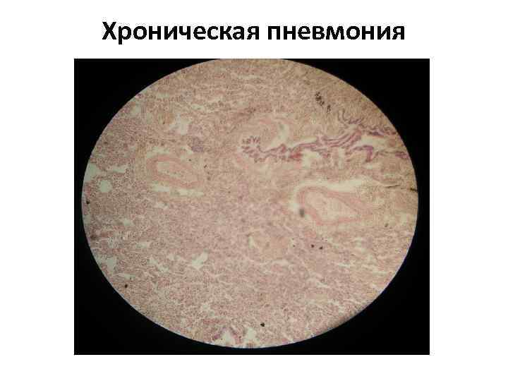 Хроническая пневмония 