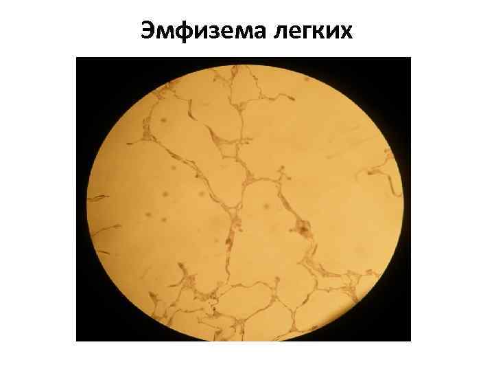 Эмфизема легких 