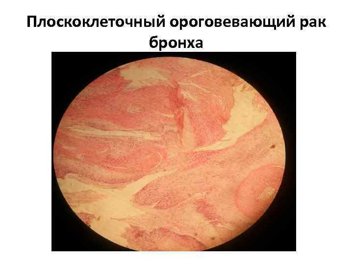 Плоскоклеточный ороговевающий рак бронха 