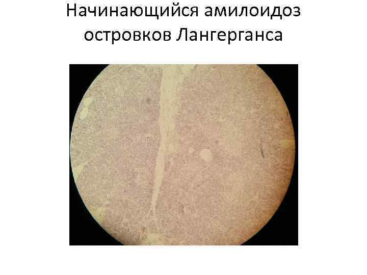 Начинающийся амилоидоз островков Лангерганса 