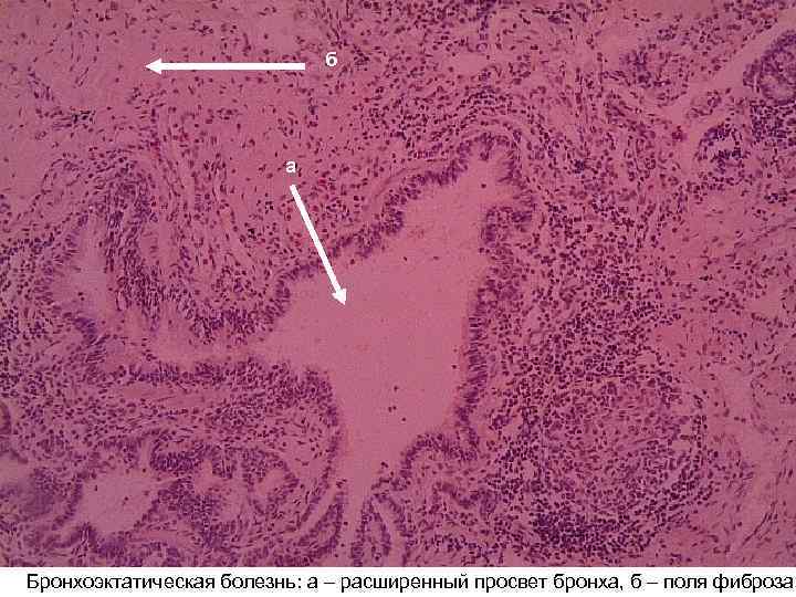 б а Бронхоэктатическая болезнь: а – расширенный просвет бронха, б – поля фиброза 