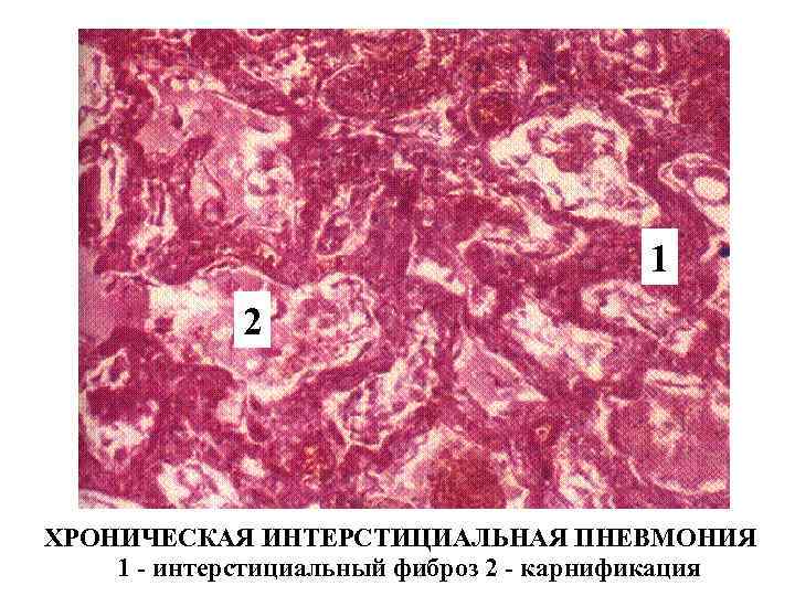 1 2 ХРОНИЧЕСКАЯ ИНТЕРСТИЦИАЛЬНАЯ ПНЕВМОНИЯ 1 - интерстициальный фиброз 2 - карнификация 