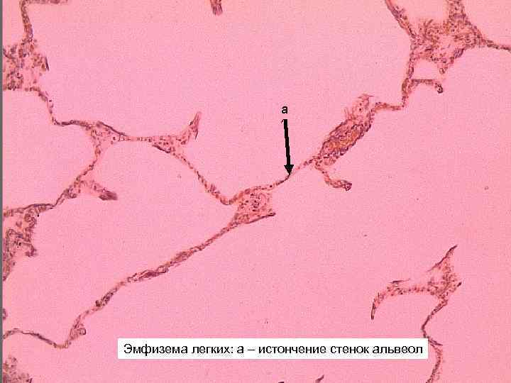 а Эмфизема легких: а – истончение стенок альвеол 