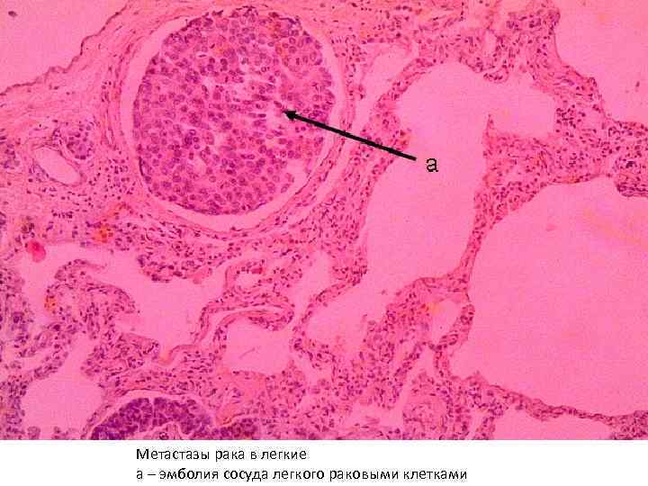 Метастазы рака в легкие а – эмболия сосуда легкого раковыми клетками 