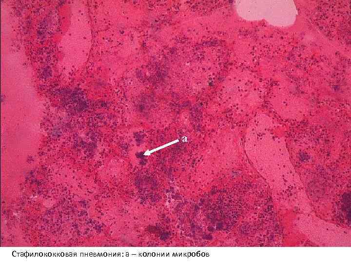а Стафилококковая пневмония: а – колонии микробов 