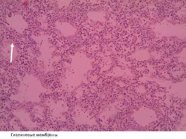 Гиалиновые мембраны 
