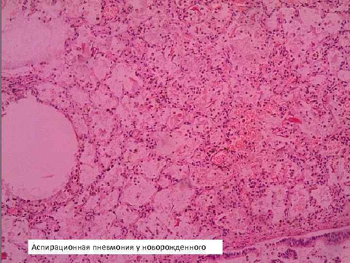Аспирационная пневмония у новорожденного 
