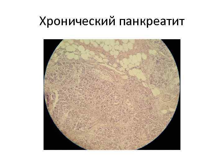 Хронический панкреатит 