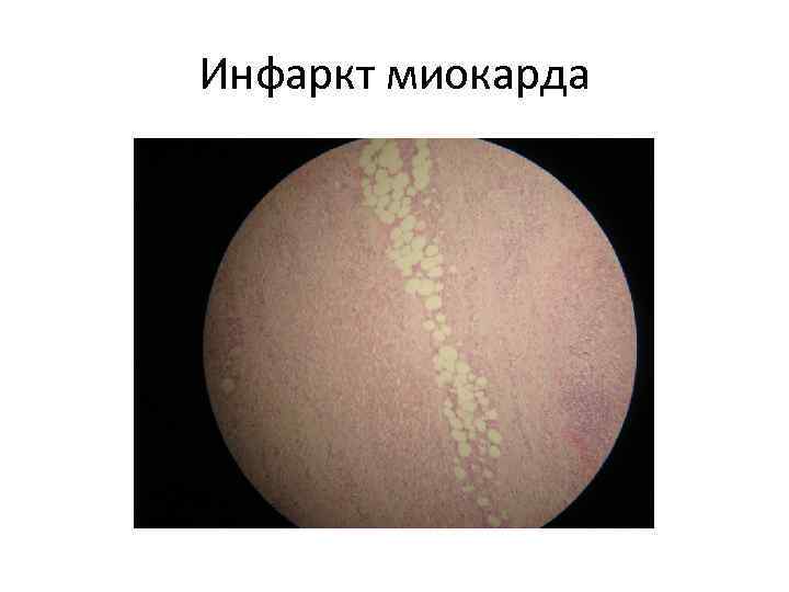 Инфаркт миокарда 