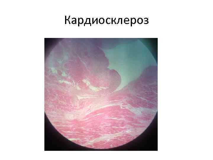 Кардиосклероз 