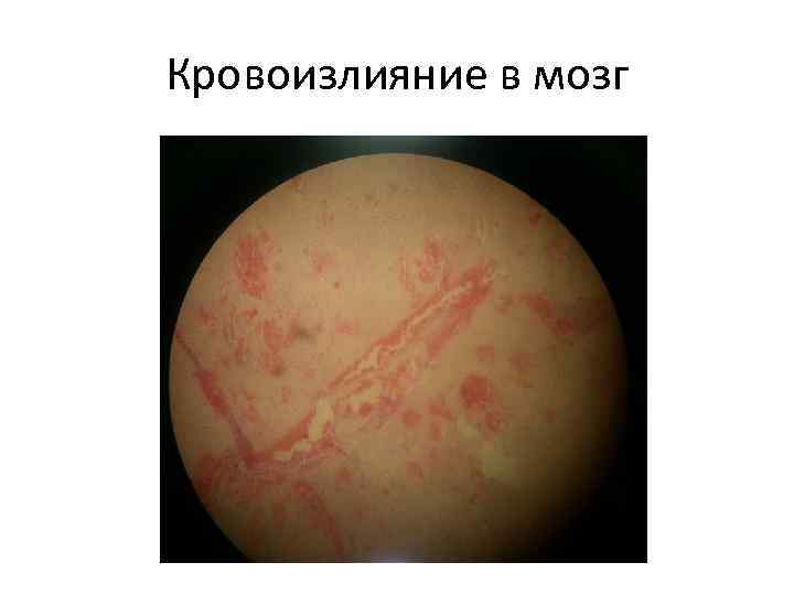 Кровоизлияние в мозг 