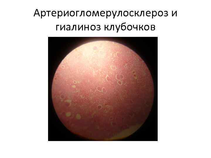 Артериогломерулосклероз и гиалиноз клубочков 