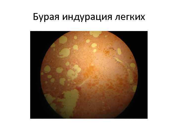 Бурая индурация легких 