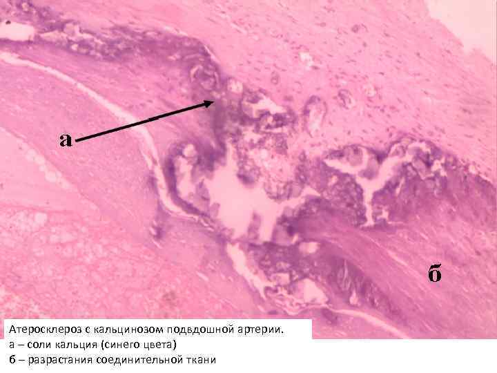 Атеросклероз с кальцинозом подвдошной артерии. а – соли кальция (синего цвета) б – разрастания