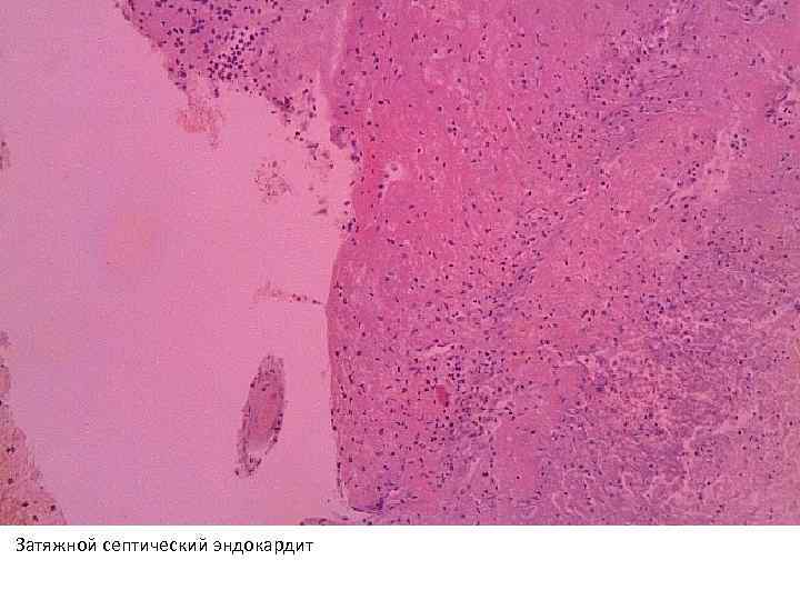 Затяжной септический эндокардит 