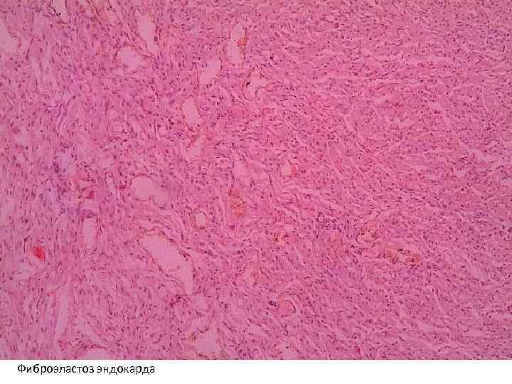 Фиброэластоз эндокарда 