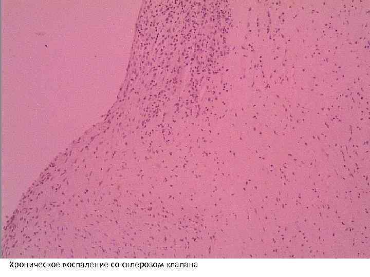 Хроническое воспаление со склерозом клапана 