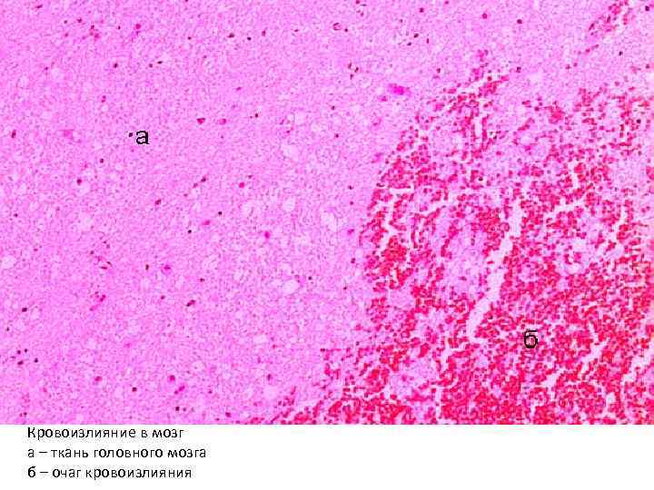 Кровоизлияние в мозг а – ткань головного мозга б – очаг кровоизлияния 