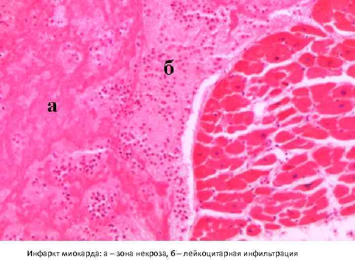 Инфаркт миокарда: а – зона некроза, б – лейкоцитарная инфильтрация 