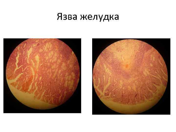 Язва желудка 