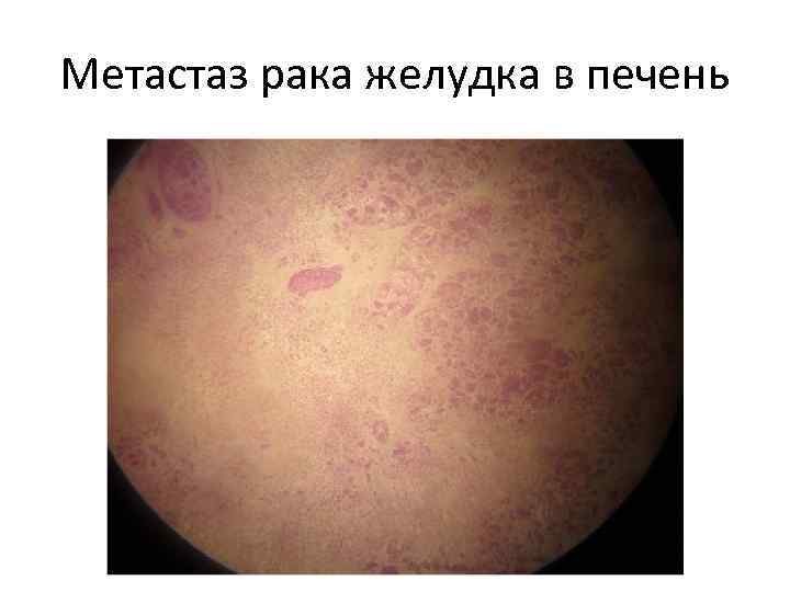Метастаз рака желудка в печень 
