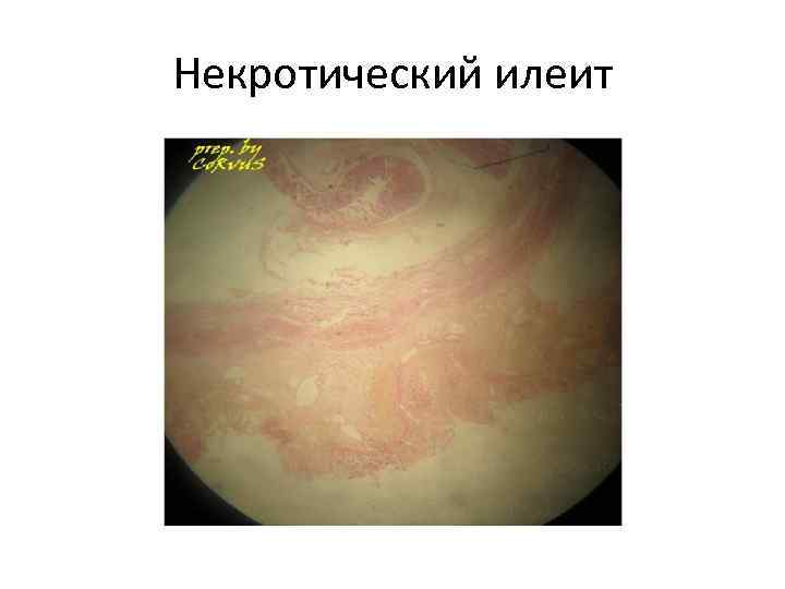 Некротический илеит 