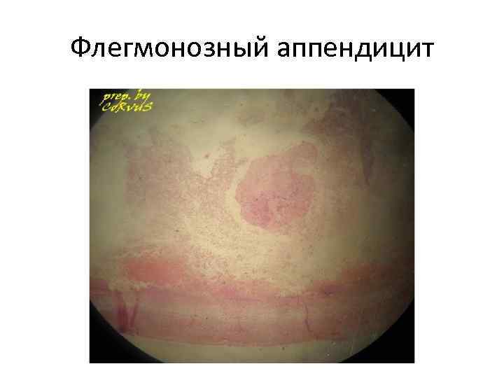 Флегмонозный аппендицит 