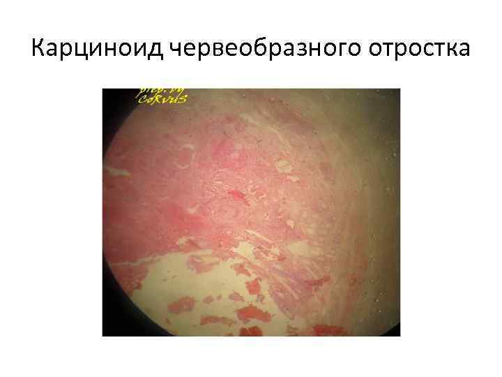 Карциноид червеобразного отростка 