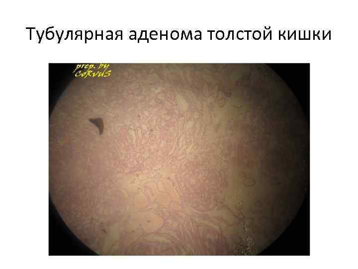 Тубулярная аденома толстой кишки 