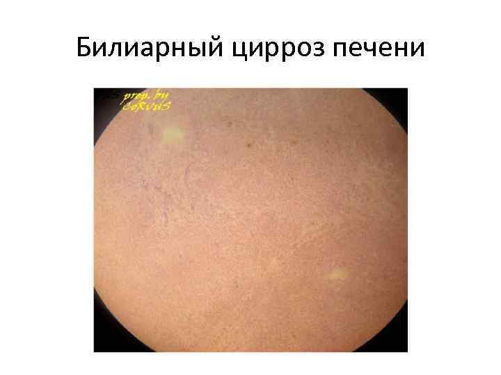 Билиарный цирроз печени 