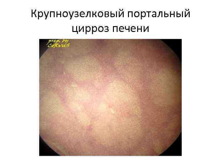 Крупноузелковый портальный цирроз печени 