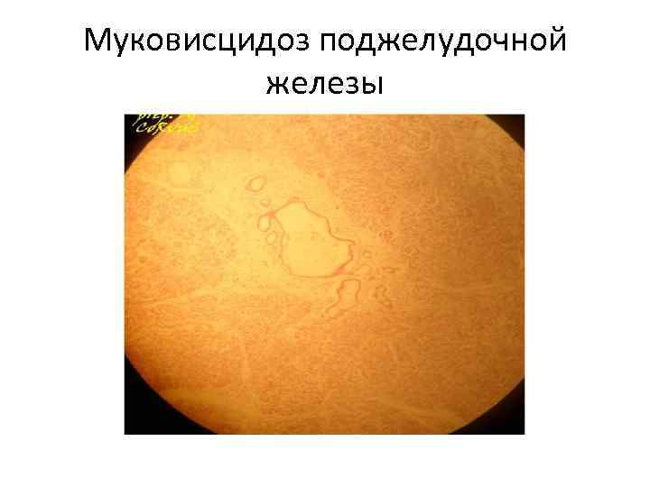 Муковисцидоз поджелудочной железы 