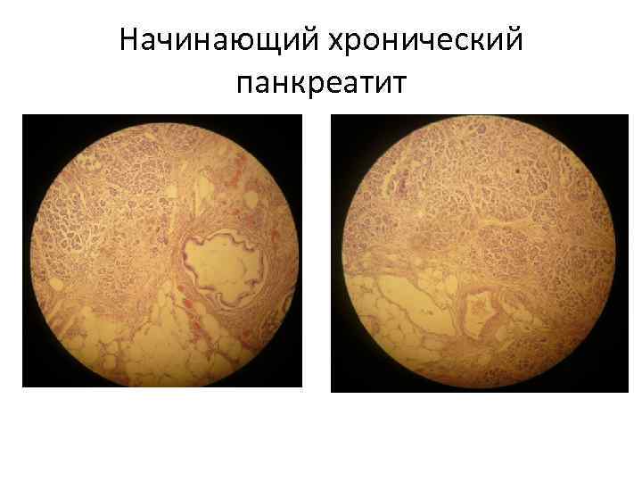 Начинающий хронический панкреатит 
