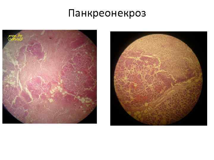 Панкреонекроз 