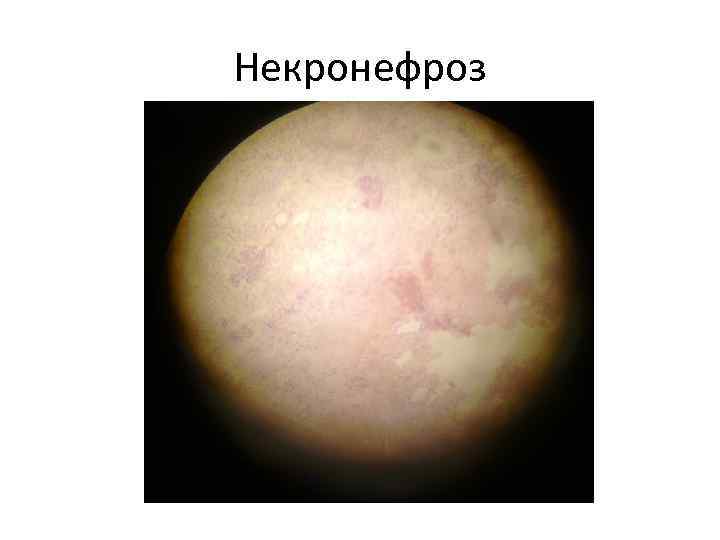 Некронефроз 