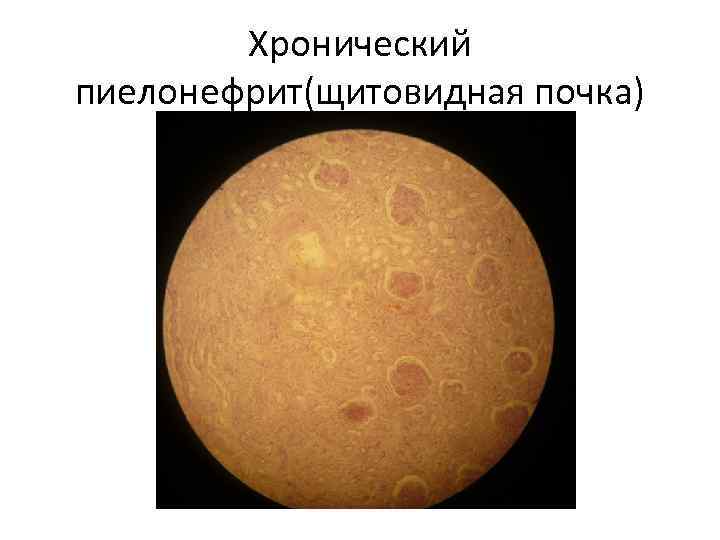 Хронический пиелонефрит(щитовидная почка) 