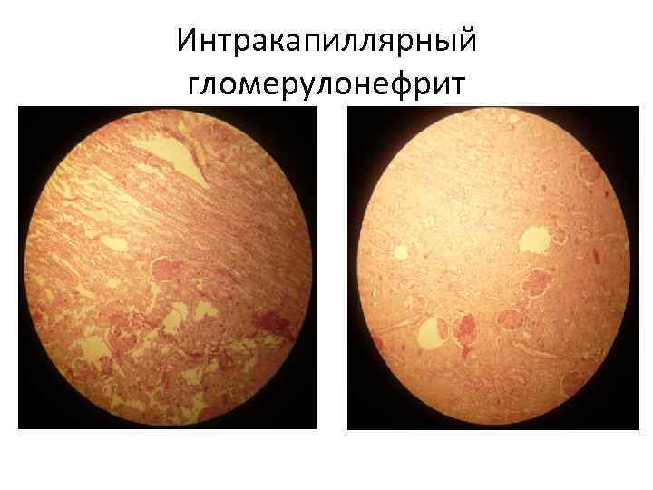 Интракапиллярный гломерулонефрит 