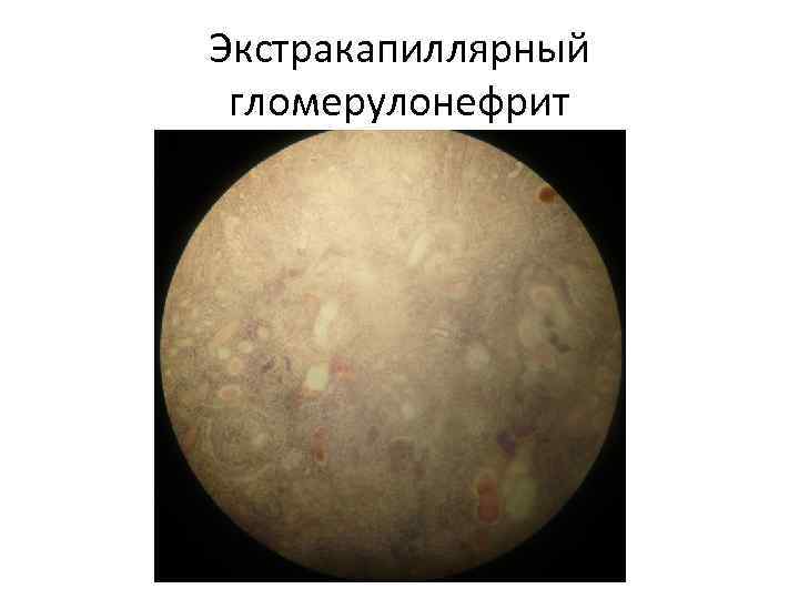 Экстракапиллярный гломерулонефрит 