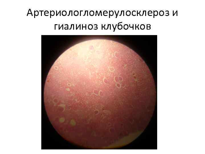 Артериологломерулосклероз и гиалиноз клубочков 
