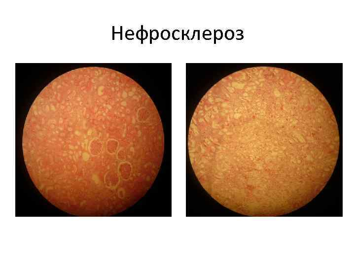 Нефросклероз 