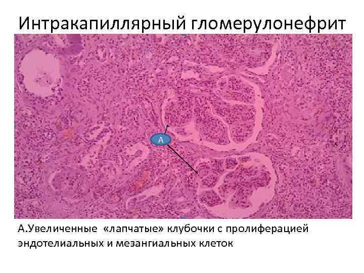Интракапиллярный гломерулонефрит А А. Увеличенные «лапчатые» клубочки с пролиферацией эндотелиальных и мезангиальных клеток 
